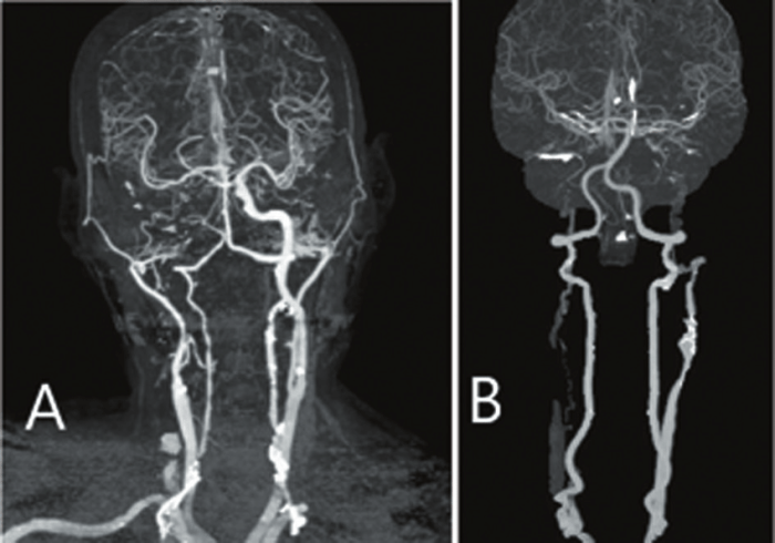 Internal carotid artery occlusion motor deficits