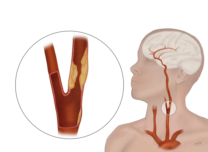 Internal carotid artery occlusion motor deficits