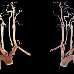 Carotid occlusion artery catheter proximal