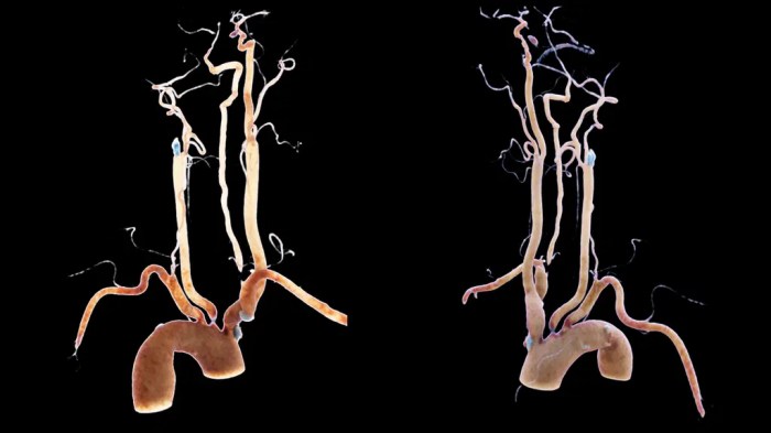 Carotid occlusion artery catheter proximal